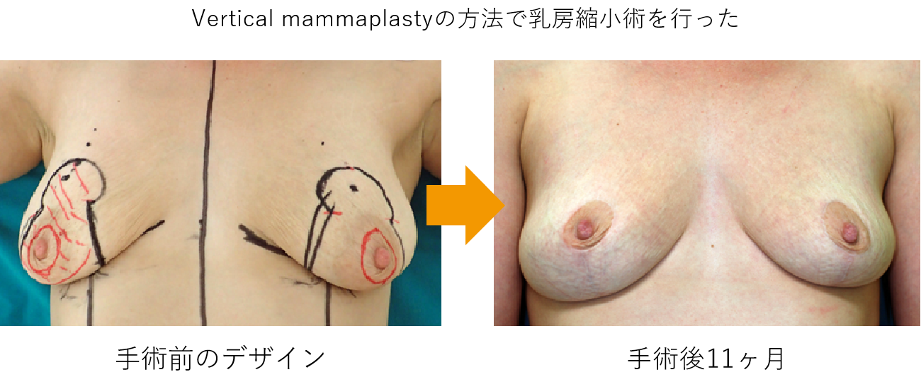 乳房再建症例